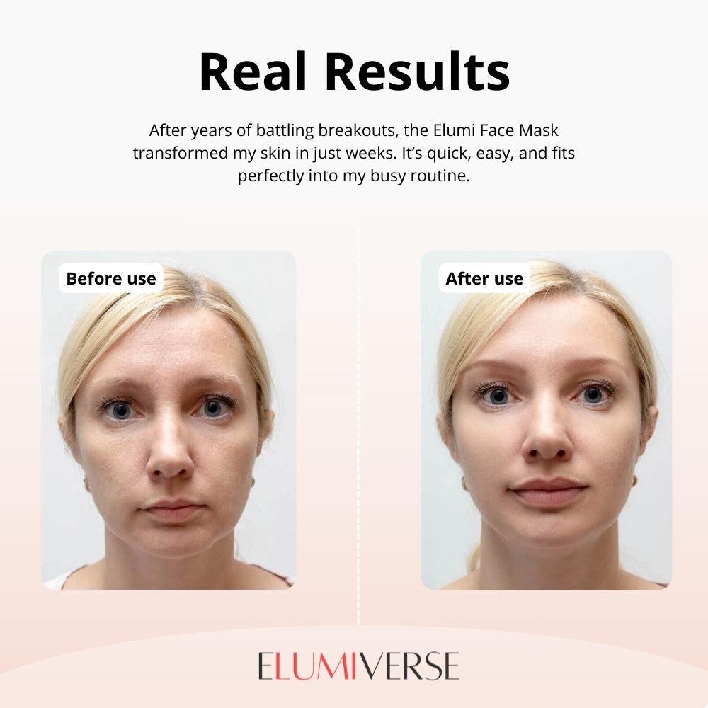 Elumi Light Therapy Mask