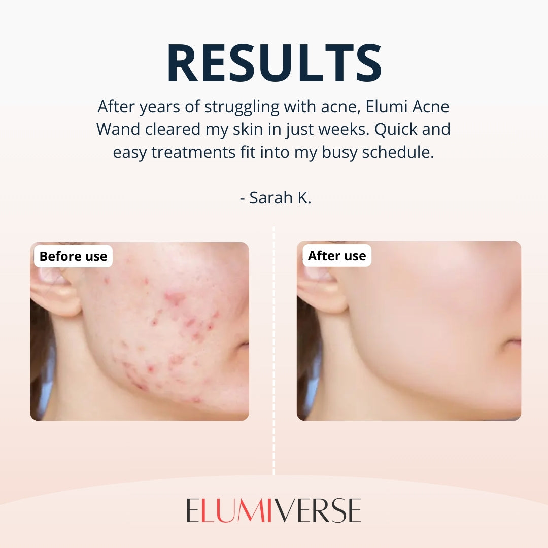 Elumi Acne Wand